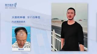 珠海無痕植髮超大面積案例曝光 5115單位Yonghe hair transplant