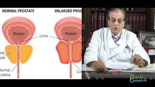 تضخم البروستات الحميد مع البروفيسور سمير السامرائي من مدينة دبي الطبية