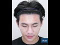 review ปลูกผม 6 เดือน“ผมหนา ขึ้นแน่นทุกกราฟต์”เลือกปลูกผม เลือก banngkok hair clinic