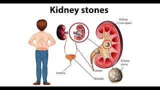 Renal  stones/kidney stones