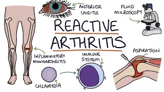 Reactive arthritis | Drk