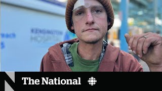 How a flesh-rotting ‘zombie drug’ is complicating the overdose crisis