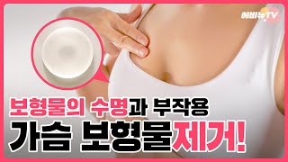 가슴 보형물 제거 꼭 해야만 하나요? 보형물 부작용 및 수명은?