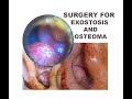 MASSIVE EXOSTOSIS AND EAR CANAL OSTEOMA SURGERY