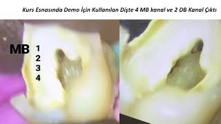 Endodontide Gizli Kök Kanalları Nasıl Bulunur ve Şekillendirilir ?