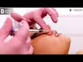 jaw reshaping procedure – how is it done get the perfect jawline dr. srikanth v doctors circle