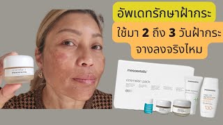 Day 2 \u0026 3 อัพเดตใช้ครีมรักษาฝ้า Cosmelan pack หน้าลอก หน้าแดง ฝ้าจางลงจริงไหมแค่สามวัน