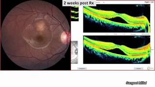 Masquerades of Central Serous Chorioretinopathy (CSCR)