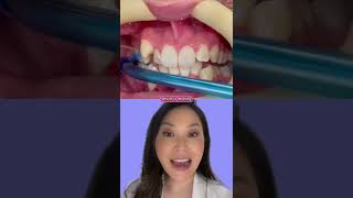 How Braces brackets are placed #braces