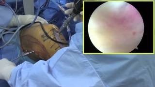 Arthroscopic Meniscocapsular Junction Repair by Dr Patrick Jost