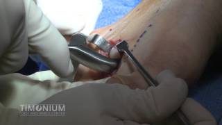 Hammertoe repair and removal of prominent metatarsal head