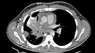 STR Cardiothoracic Case Webinar 10/27/2022