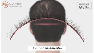 절개 모발이식 과정 (FUSS Hair Transplantation) l 김경복원장 l 모먼트의원(MOMENT)