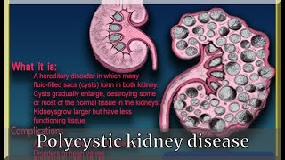 Polycystic kidney disease | Kidney disease Types