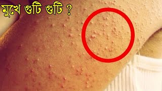 মুখে ছোট ছোট গুটি দানার মতোTiny Bumps বের হলে ১ মিনিটেই সমাধান দেখুন। চিরদিনের জন্য দূর হয়ে যাবে