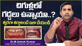 చిగుళ్లలో గడ్డలు తగ్గాలంటే || How to Reduce Gum Swelling and Pain Telugu || Eledent Dental Hospitals