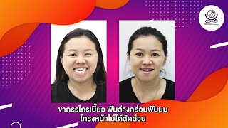 จัดฟันจัดโครงสร้างใบหน้า - ขากรรไกรเบี้ยว ฟันล่างคร่อมฟันบนโครงหน้าไม่ได้สัดส่วน โดยไม่ผ่าตัด