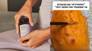 איך מתמודדים עם חצ׳קונים ? פצעונים? פצעי בגרות?