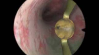 Rollerball Endometrial Ablation - Virtual Reality Simulation for Endoscopic Surgery