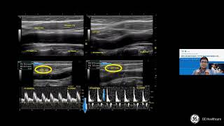 [CME SAMM] 2.3 Siêu âm Doppler động mạch cảnh-một số bệnh lý khác - BS Nguyễn Quang Trọng