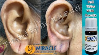 Ear Pasting Lotion Available Torn Ear lobe /Ear Lobing Torn Ear / Hole Repair  /Ear lobe Repaire