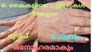 അടുക്കള ജോലി വാഷിംഗ് എന്നിവ മൂലം കൈകളിൽ ഉണ്ടാവുന്ന ചുളിവുകൾ തഴമ്പുകൾ ഇരുളിമ ഒറ്റദിവസംകൊണ്ട് അകറ്റാം