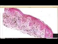 pigmented spindle cell nevus of reed reed nevus subtype of spitz nevus pathology histology