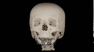 Anterior mandible segment implant