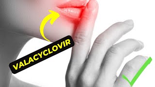 Valacyclovir: The Antiviral Medication That Can Help Treat Herpes and Cold Sores