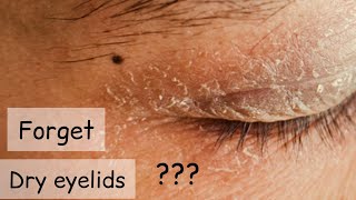 Dryness on Eyelids and Face Simple Home Remedy  ?? Dry Skin around Eyelids Treatment ??