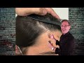 amazing hair transplant results in miami