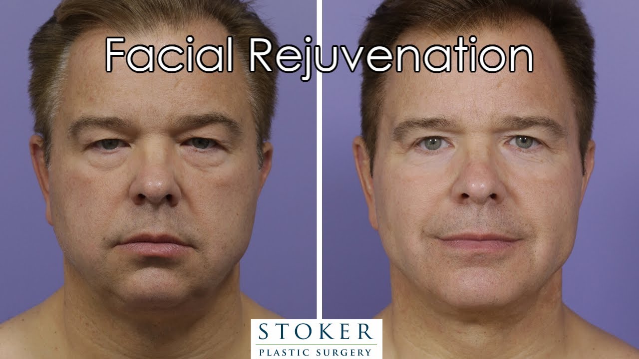 Male Facial Plastic Surgery Los Angeles: Dr. Stoker Reviews His ...