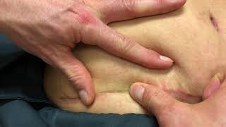 Tummy Tuck & Breast Augmentation Scars 6 Weeks After Surgery | Dr. Piazza Explains