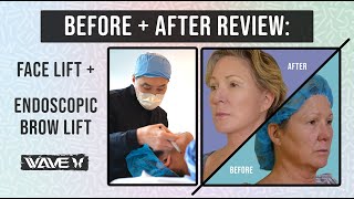 Before and After: Facelift with an Endoscopic Brow lift | Wave Plastic Surgery