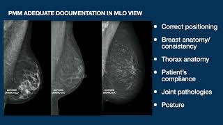 HOW TO SHOW PECTORALIS MAJOR MUSCLE IN MLO PROJECTION: FIRST PART