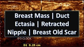 Breast Mass || Duct Ectasia || Retracted Nipple || Breast Old Scar