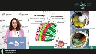 Меланома глаза. Взгляд патоморфолога (Артемьева А.С.)