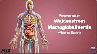 Waldenstrom Macroglobulinemia: Symptoms, Progression, and Treatment