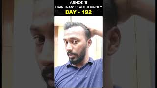 #AskDrJohnWatts | DAY - 192 of ASHOK’S HAIR TRANSPLANT JOURNEY | #besthairtransplant #drjohnwatts