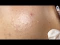 Acne Treatment For Teen Customers | Trị Mụn Cho Bạn Khách Tuổi Teen - SacDepSpa#253