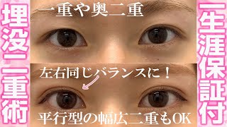 【二重にする方法】わずか15分！切らない二重整形（一生保証）とは？【湘南美容クリニックの医師が解説】