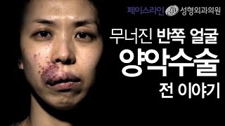 무너진 반쪽얼굴에서 렛미인 최고미녀로 변신한 그녀의 양악수술