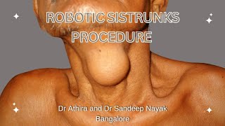 Robotic Sistrunk Procedure for Thyroglossal Cyst using RABIT Approach.