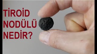 tiroid nodülü nedir