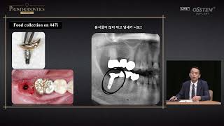 [PROSTHODONTICS] Biologic Complications of Implants related to Abutment and Prosthetic Design