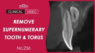 Extraction of supernumerary tooth / Lingual torus removal - [Dr. Cho Yongseok]