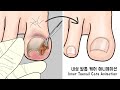 ASMR Coolness! Ingrown Toenail removal treatment animation