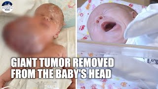 Ukrainian baby boy life’s saved after having a giant tumor removed from head