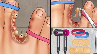 ASMR tickling feet | ASMR ingrown toenail removal animation