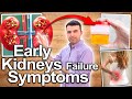 EARLY KIDNEY FAILURE SYMPTOMS - Signs Most People Will Miss